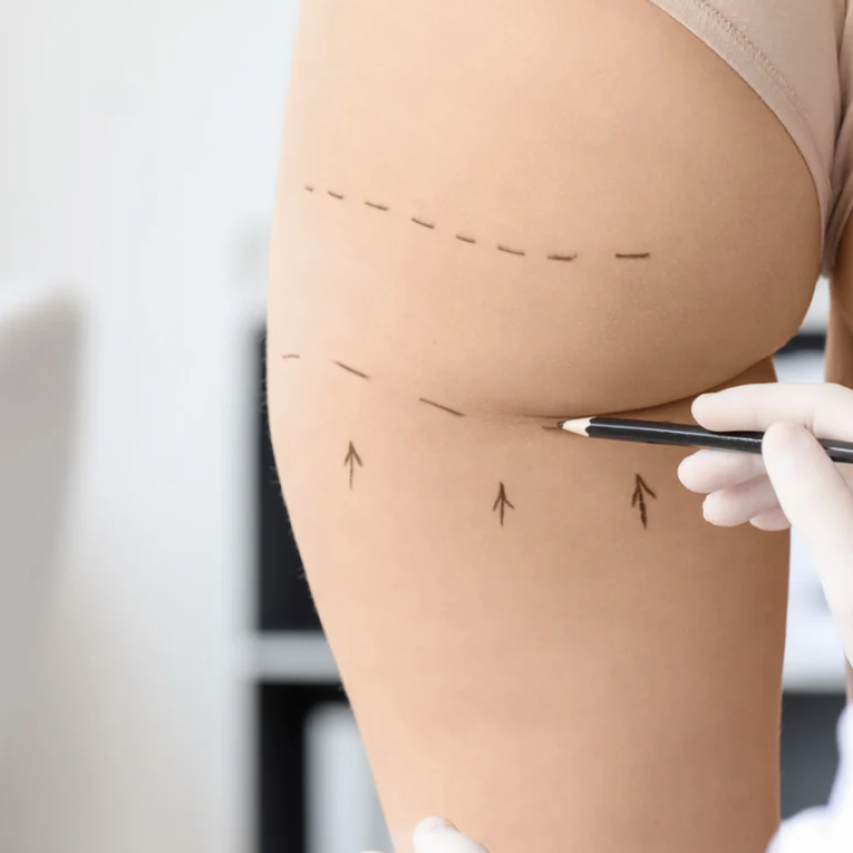 Free Quote for Liposuction in Herndon or Reston VA